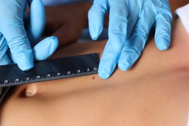 Doktor hastanede Cetvel ile genç kadının köstebeğini inceliyor.