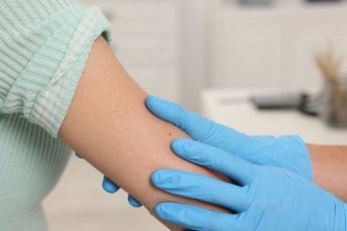 Hastanede genç bir kadının köstebeğini muayene eden doktor, yakın plan.