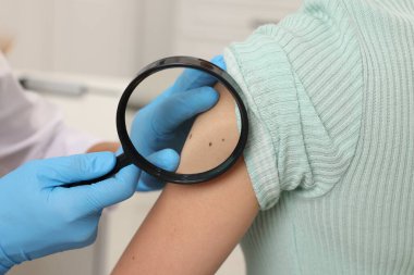 Hastanede büyüteçle genç kadının benini inceleyen doktor, yakın plan.