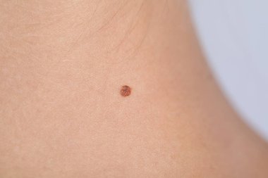 Vücudunda benli bir kadın açık gri arka planda, yakın plan.