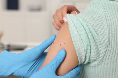 Hastanede genç bir kadının köstebeğini muayene eden doktor, yakın plan.