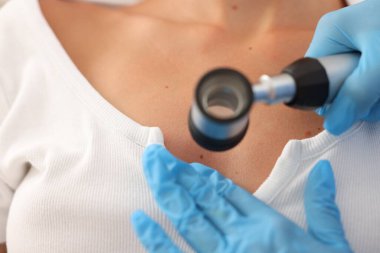 Doktor hastanede dermatoskopla genç kadının benini inceliyor.