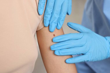 Hastanede genç bir kadının köstebeğini muayene eden doktor, yakın plan.