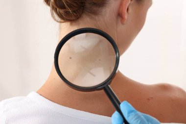 Doktor beyaz arka planda büyüteçle genç kadının benini inceliyor.