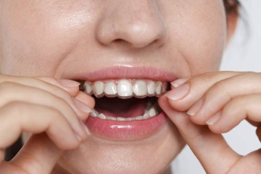 Gri arka planda diş hizalayan kadın, yakın plan.