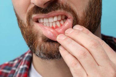 Açık mavi arkaplanda iltihaplı sakız gösteren adam, yakın plan