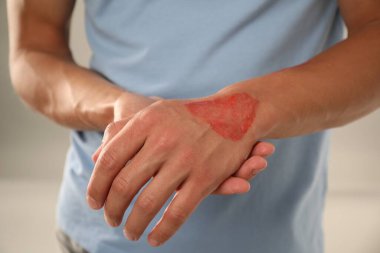 Açık gri arka planda yanmış eli olan adam, yakın plan.