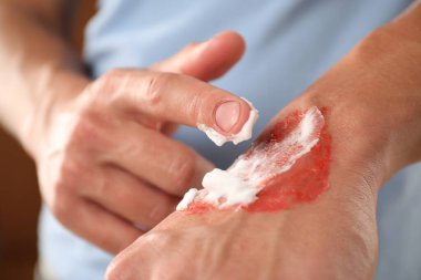 Kahverengi arka planda yanmış ellere iyileştirme kremi süren adam, yakın plan.