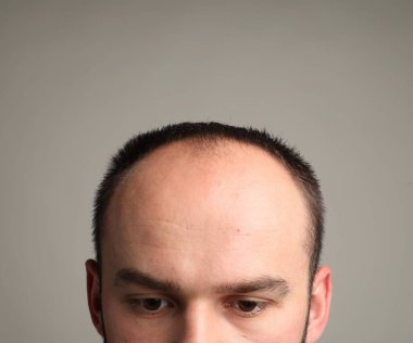 Kellik sorunu. Gri arkaplanda saç çizgisi olan adam, yakın plan.