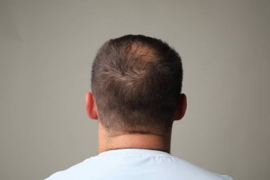 Gri arka planda kel bir adam var.