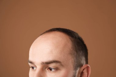 Kellik sorunu. Kahverengi arka planda saç çizgisi olan adam, yakın plan.