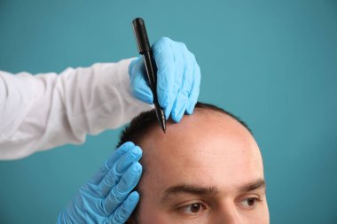 Kellik sorunu. Tıbbi eldivenli doktor, açık mavi arka planda saç nakli ameliyatından önce hastanın kafasına işaretler çiziyor.