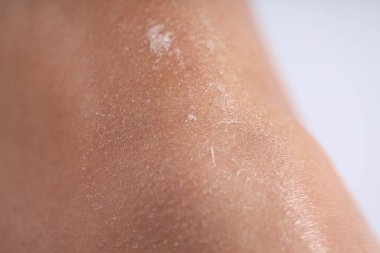 Bacağında kuru deri olan kadın arka planda, yakın plan.