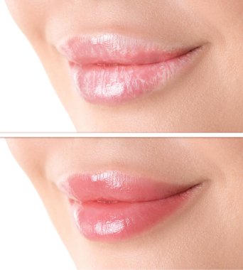 Dudak bakımı. Çatlamış ve kurumuş ciltli bir kadın. Nemlendirici tedaviden sonra sağlıklı bir cilt. Yakın plan. Beyaz arkaplanda kolaj