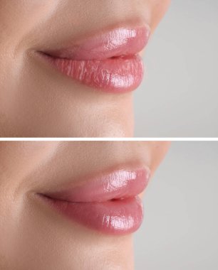 Dudak bakımı. Çatlamış ve kurumuş ciltli bir kadın. Nemlendirici tedaviden sonra sağlıklı bir cilt. Yakın plan. Gri arkaplanda kolaj