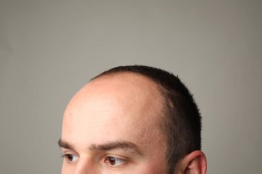 Kellik sorunu. Gri arkaplanda saç çizgisi olan adam, yakın plan.