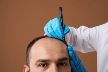Kellik sorunu. Tıbbi eldivenli doktor, kahverengi arka planda saç nakli ameliyatından önce hastanın kafasına işaretler çiziyor.