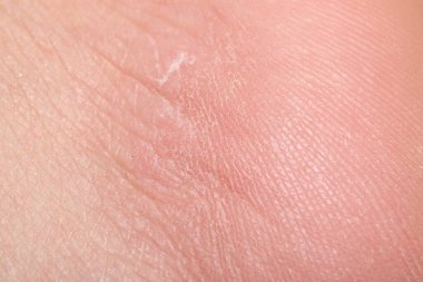 Arka planda kırışıklıklar olan kuru insan derisinin makro görünümü