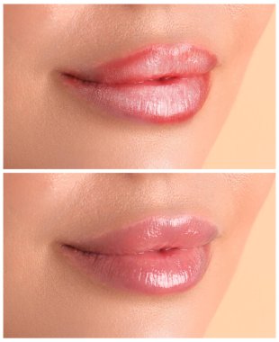 Dudak bakımı. Çatlak ve kuru ciltli bir kadın. Nemlendirici tedaviden sonra sağlıklı bir cilt. Kolaj.