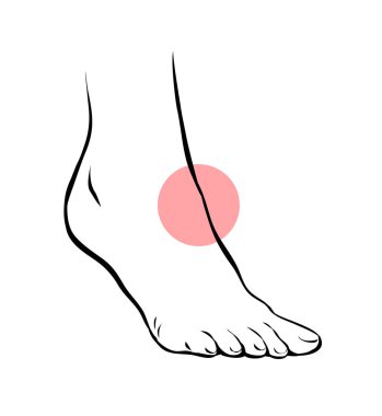 Çizgi, kadın bacağının sorunlu bir resmini çiz. Ortopedik hastalık. Ayakların güzelliği ve sağlığı. Vektör izole edilmiş taslak çizimi