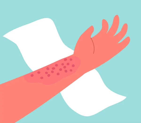 人間の手の皮膚の皮膚炎 皮膚科疾患 症状はかゆみ 発赤と発疹です アレルギー反応 医療診断と治療 ベクターイラスト — ストックベクタ