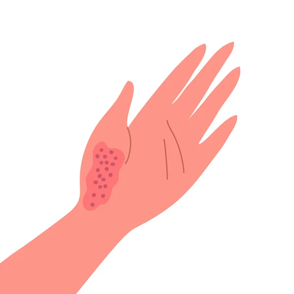 人类手部皮肤上的皮炎 皮肤科疾病 症状是瘙痒 红肿和皮疹 过敏反应 医疗诊断和治疗 矢量说明 — 图库矢量图片