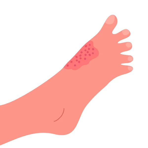 人类腿皮肤上的皮炎 皮肤科疾病 症状是瘙痒 红肿和皮疹 过敏反应 医疗诊断和治疗 矢量说明 — 图库矢量图片