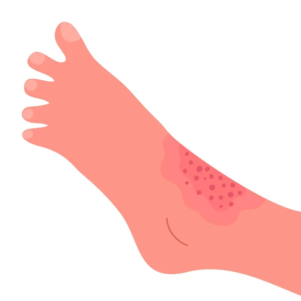 Dermatit Huden Ett Mänskligt Ben — Stock vektor