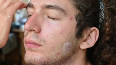 Kafkas derisi iltihabından muzdarip genç bir adamın portresini gösteren görüntüler: üzerinde bir doz antibiyotik krem bulunan parmak, yaralara ince bir tabaka yayar.