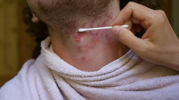 一个年轻的白种人患有类风湿性皮炎脸的特写镜头 用棉签检查皮肤和片状皮疹的状况 — 图库视频影像