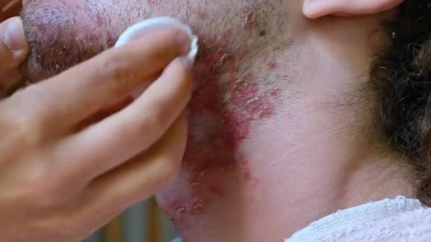 Bőrápolás Cotton Pad Áztatott Micelláris Vízben Dörzsölik Arcát Egy Fiatal — Stock videók