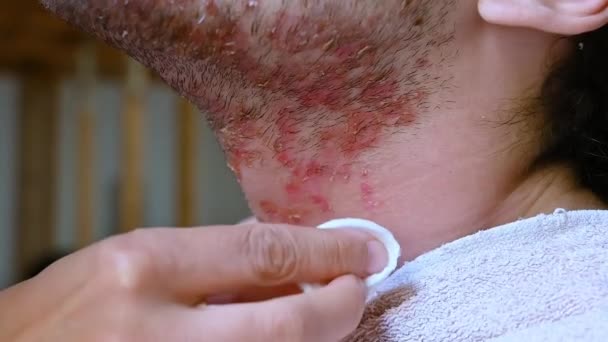 피부염으로 고통받는 코카서스 사람의 얼굴의 초상화와 패드는 피부를 청소하기 미세한 — 비디오