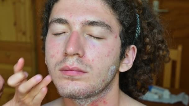 皮脂性皮膚炎に苦しんでいる若い白人男性の顔の肖像画 抗生物質クリームの線量が鼻に層を広げる指 彼は笑顔 — ストック動画