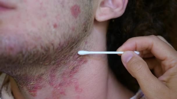 피부염으로 고통받는 남자의 얼굴의 클로즈업 이미지와 피부와 발진의 상태는 면봉으로 — 비디오