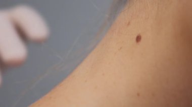Bir dermatolog bir kadının boynundaki beni klinikte büyüteçle inceliyor. Doktor büyütülmüş bardağı benine yaklaştırıyor.