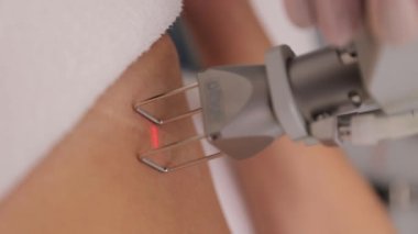 Cildindeki gerilme izlerinin lazerle öğütülmesi. Donanım kozmetolojisi. Cilt bakımı kliniğinde lazerin varlığı, cilt kırışıklıklarını, yara izlerini ve güneş ışınlarını iyileştiren bir teknik..