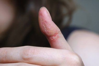 Realistic photo of skin damage from biting fingers during anxiety