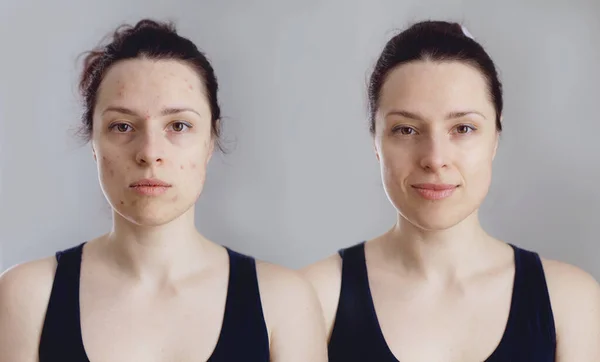 Composed naturally edited before and after image of a woman with dry damaged skin covered with blemishes and freshly moisturised supple healed complexion