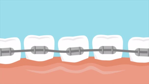 Dentes Com Aparelho Processo Alinhamento Animação Medicamente Precisa Imagens Alta — Vídeo de Stock