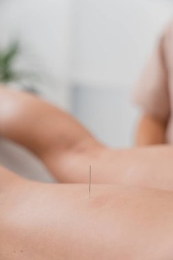 Ağrı yönetimi ve iyileşme için yapılan fizyoterapi seansı sırasında hastanın bacağına yerleştirilen akupunktur iğnesinin yakın çekimi.