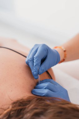 Kadın hastalara kuru iğne tedavisi uygulayan fizyoterapist, ağrı yönetimi ve kas rehabilitasyonu için kullanılan bir yöntem