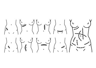 Abdominal kesik çizgisi simgeleri ayarlandı. 