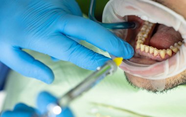 Diş hekimi hastanın dişlerini tedavi eder. Diş kliniğine gelen hastanın ağzı açık fotoğrafı, tıbbi konsept.