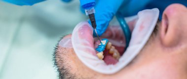 Hasta ağzını açtı, dişçi çalışıyor ve dişlerini tedavi ediyor.