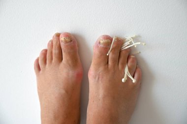 Tırnak mantarlı erkek ayakları ve yatay mantarlar..