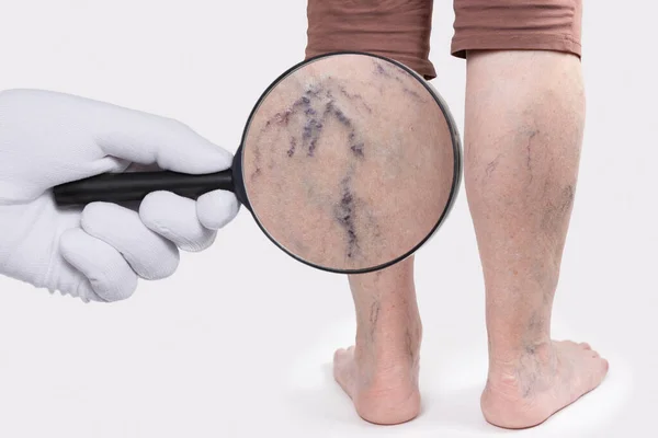 stock image Doctor's hand in a white glove shows zoomed blood vessels with a magnifying glass. Old woman with vascular asterisks on her legs. Rear view. The concept of varicose veins.