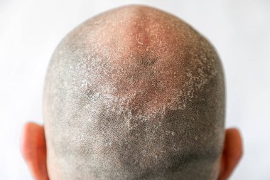 Males bald flaky head with dandruff close-up, back view. White background. The concept of psoriasis and dandruff.