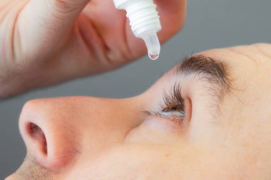 Ophthalmology. A man instills medicine into his eye. Close-up. The concept of irritation and dryness, eye diseases.