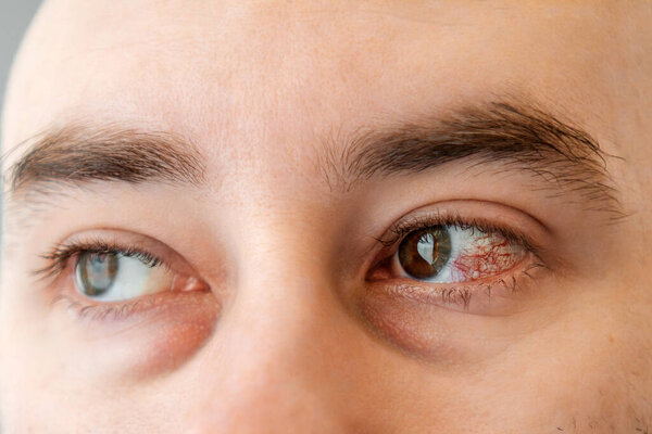 Close-up of male brown eyes with bruises, redness and burst vessels. The concept of irritation, inflammation and bacterial disease.