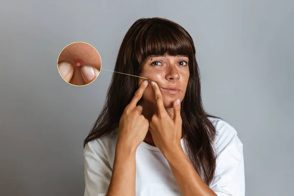 Acne Cosmetology Tanned Young Woman Squeezes Pimple Her Face Enlarged — Stock Photo, Image